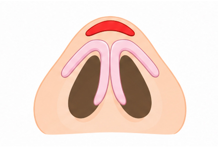 Type1 수술 후