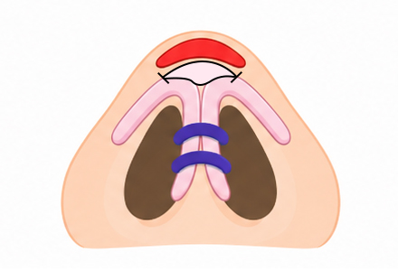 Type3 수술 후